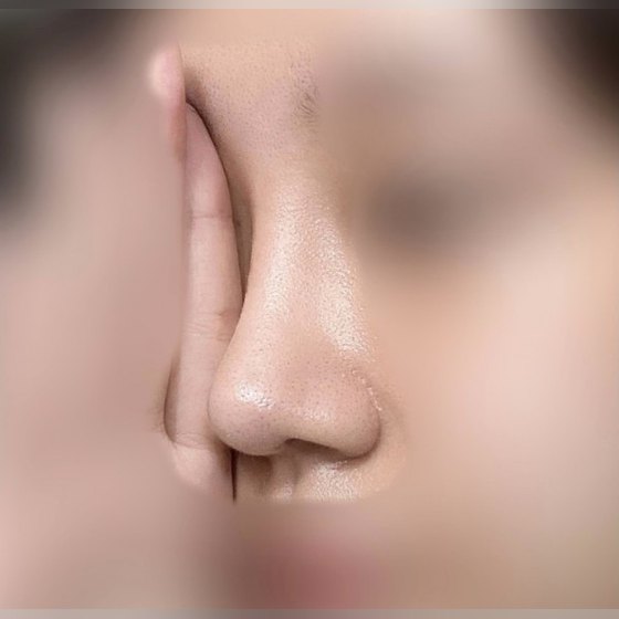 Ảnh thu nhỏ bài review thẩm mỹ mũi — Review thật 100% về nâng mũi chức năng !!