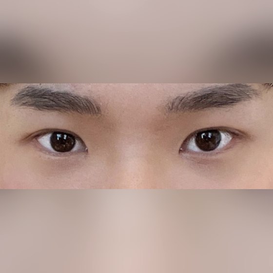Ảnh thu nhỏ bài review thẩm mỹ mắt — Hành trình thoát khỏi mặc cảm vì mắt lệch!