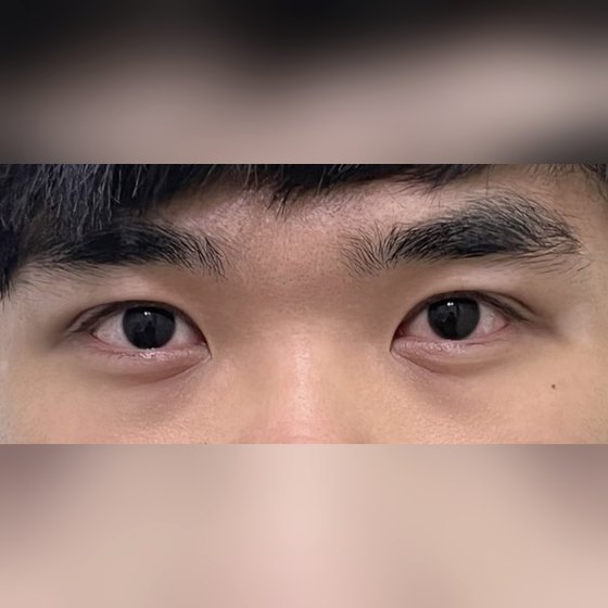 Ảnh thu nhỏ bài review thẩm mỹ mắt — Hoàn toàn hài lòng!!!