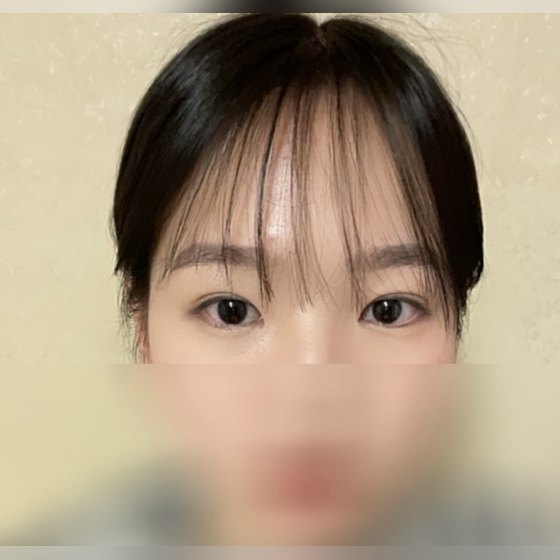 Ảnh thu nhỏ bài review thẩm mỹ mắt — Phẫu thuật mắt hai mí của bác sĩ Oh là số một!!!!