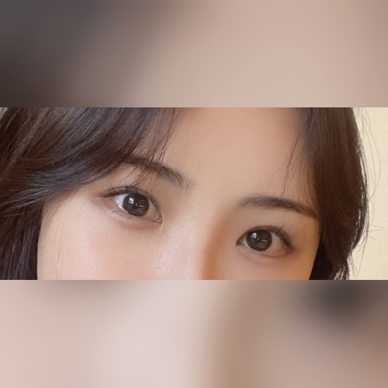 Ảnh thu nhỏ bài review thẩm mỹ mắt — Phẫu thuật mắt lại, cực kỳ hài lòng!!!!!!