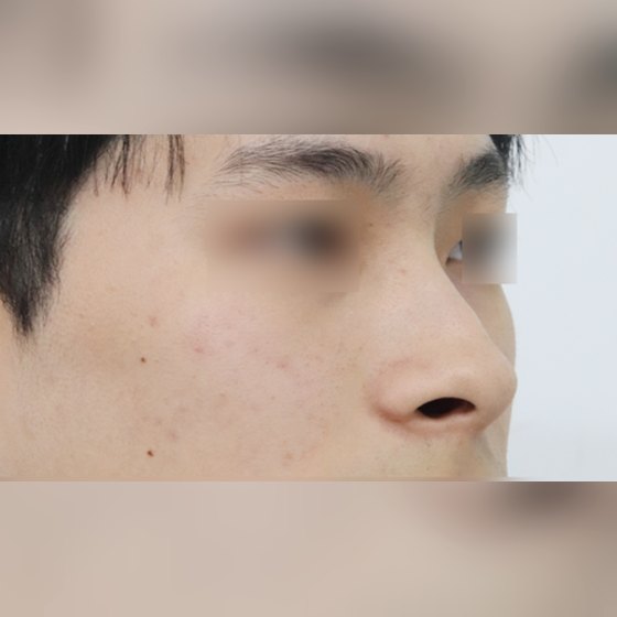 Ảnh thu nhỏ bài review phẫu thuật mũi — Review chỉnh mũi khoằm cho nam