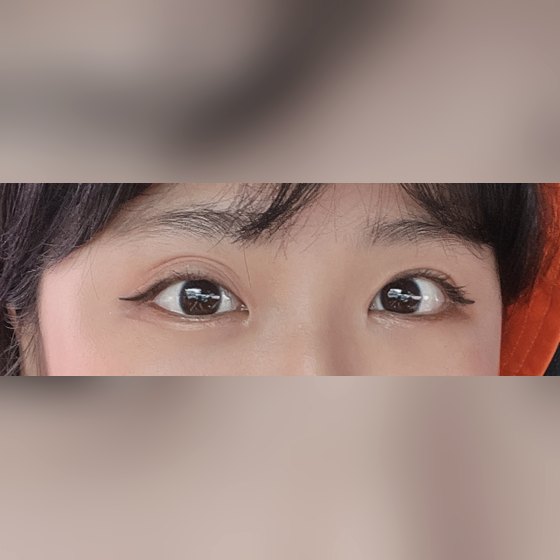 Ảnh thu nhỏ bài review phẫu thuật mắt — [Sửa mắt lại] Đã hai tháng kể từ khi mình sửa mắt lại tại Four Seasons