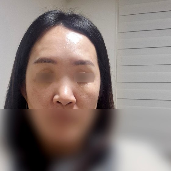 Ảnh thu nhỏ bài review phẫu thuật mũi — Review phẫu thuật mũi chức năng tại Phòng khám Phẫu thuật Thẩm mỹ Four Seasons, Busan