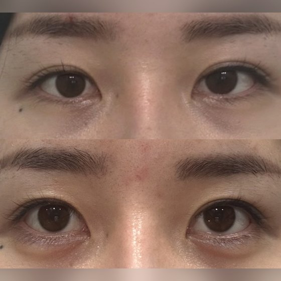 Ảnh thu nhỏ bài review tiêm thẩm mỹ — Mình đã tiêm filler bọng mắt cười tại Phòng khám Phẫu thuật Thẩm mỹ Four Seasons
