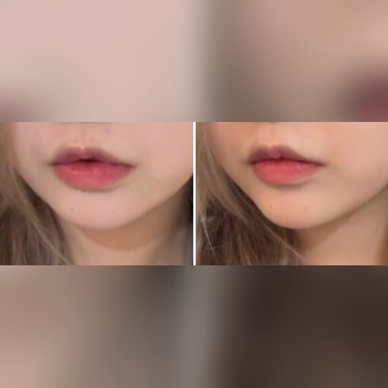 Ảnh thu nhỏ bài review tiêm thẩm mỹ — Review tiêm filler môi tại Phòng khám Phẫu thuật Thẩm mỹ Four Seasons
