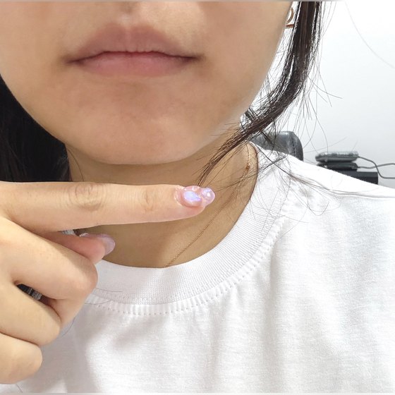 Ảnh thu nhỏ bài review tiêm thẩm mỹ — Tiêm filler cằm tại Four Seasons Seomyeon, thoát khỏi cằm phẳng, cực kỳ hài lòng~