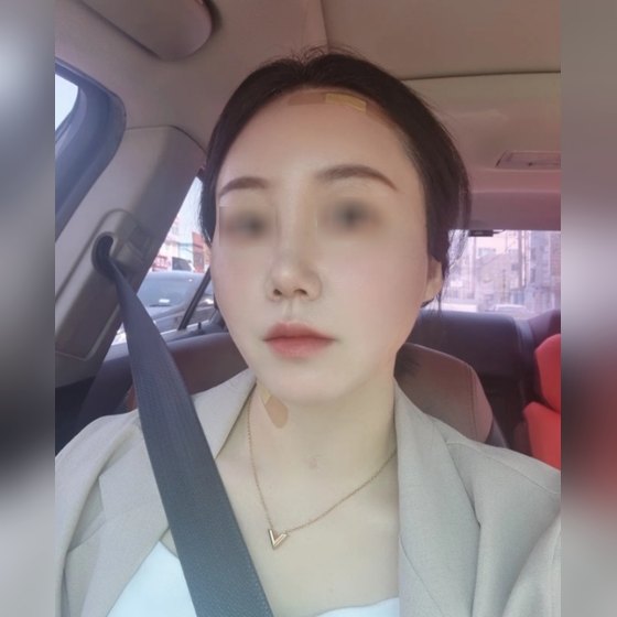 Ảnh thu nhỏ bài review nâng cơ — Má chảy xệ và nếp nhăn khóe miệng đã được cải thiện!