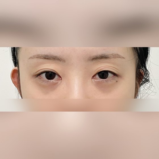Ảnh thu nhỏ bài review phẫu thuật mắt — Tiếc quãng thời gian đã phân vân chuyện sửa lại, hihi