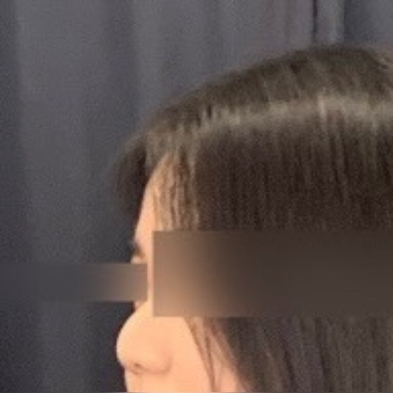 Ảnh thu nhỏ bài review phẫu thuật mũi — Người cha thứ hai của mình...