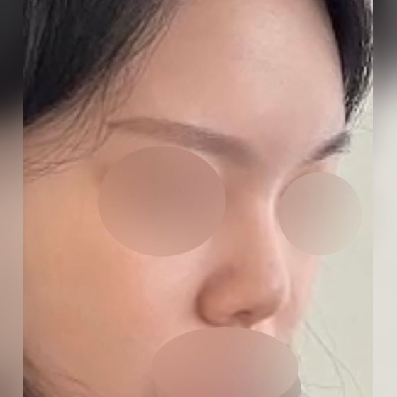 Ảnh thu nhỏ bài review phẫu thuật mũi — Review chi tiết một tháng sau phẫu thuật mũi chức năng + thẩm mỹ !