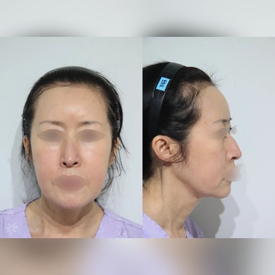 Ảnh thu nhỏ bài review phẫu thuật mũi — Bác sĩ Jegal Jeong⁠-⁠jae, Phòng khám Phẫu thuật Thẩm mỹ Four Seasons Seomyeon, phẫu thuật mũi khoằm, tròn một tháng~~~