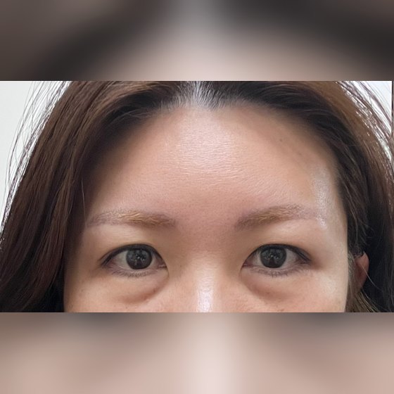 Ảnh thu nhỏ bài review phẫu thuật mắt — Nâng trán nội soi + cắt da mí trên + chỉnh dáng mắt + xử lý bọng mỡ mắt dưới, hoàn toàn hài lòng!