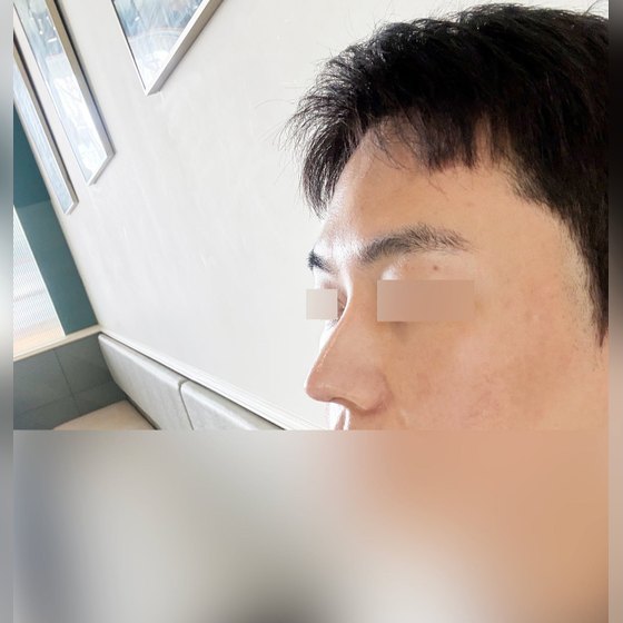 Ảnh thu nhỏ bài review phẫu thuật mũi — Ca phẫu thuật mũi lần hai tại Phòng khám Phẫu thuật Thẩm mỹ Four Seasons Busan, mình thấy có vẻ đã thành công rồi hihi