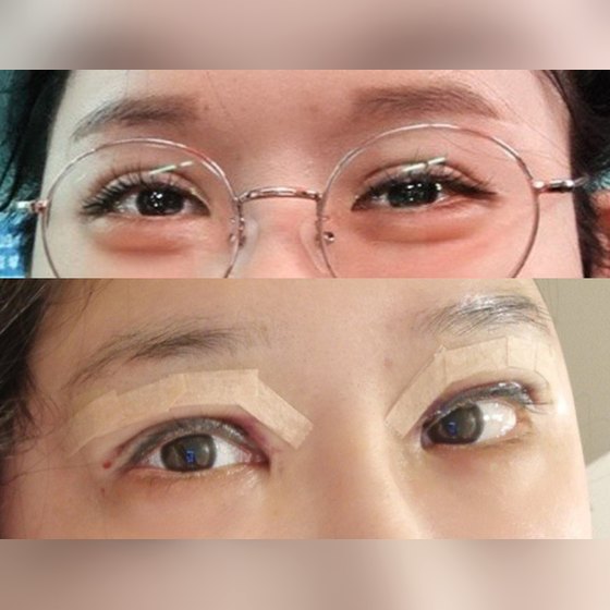 Ảnh thu nhỏ bài review phẫu thuật mắt — Review thật lòng sửa lại mí đôi dày kiểu xúc xích