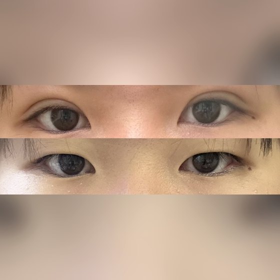 Ảnh thu nhỏ bài review phẫu thuật mắt — Review cắt mí đôi