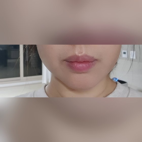 Ảnh thu nhỏ bài review tiêm thẩm mỹ — Cuối cùng mình cũng đã tiêm filler môi~