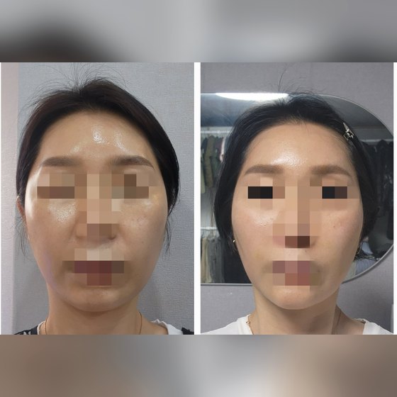 Ảnh thu nhỏ bài review nâng cơ — Review căng da bằng chỉ Mint!