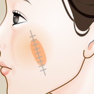Enlarged diagram of the spindle-shaped excision area in simple excision