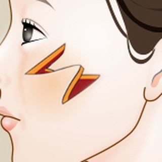 Enlarged diagram of the Z-shaped incision and triangular flaps in Z-plasty