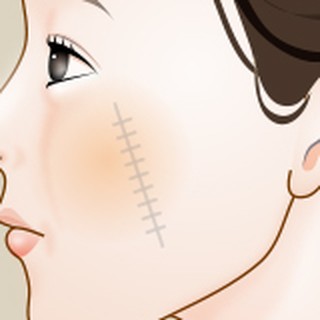 Enlarged diagram of the straight suture line in simple excision