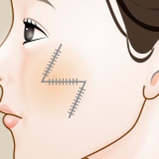 Enlarged diagram of the Z-shaped suture line in Z-plasty