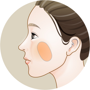 Side-profile illustration marking the scar area left on the cheek