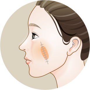 Side-profile illustration showing the entire scar excised in a spindle shape with the suture line drawn