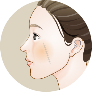 Side-profile illustration showing the scar site closed with a straight suture