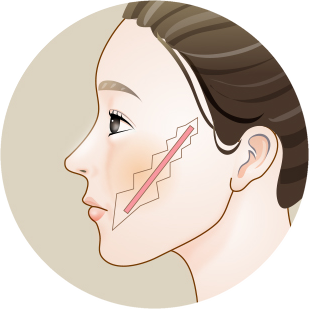 Side-profile illustration with a sawtooth-shaped excision line designed along the scar