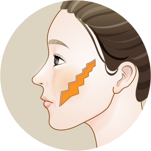 Side-profile illustration marking the area excised in a sawtooth shape