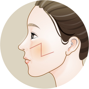 Side-profile illustration with the scar placed on the central limb of a Z and the incision lines designed with dotted lines