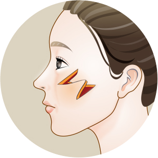 Side-profile illustration with Z-shaped incisions made and the triangular flaps lifted