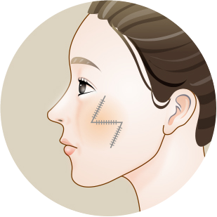 Side-profile illustration showing the scar site closed with a Z-shaped suture
