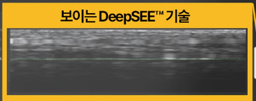 울쎄라피 프라임 화면의 DeepSEE 콜아웃 &mdash; 실시간 피부 속 초음파 단면