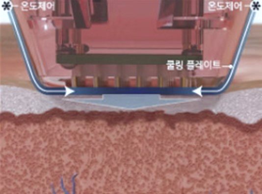 1단계 단면 도해 — 핸드피스의 쿨링 플레이트가 표피에 닿아 온도제어로 표피를 식힌다