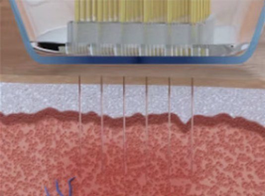 رسم مقطعي للمرحلة 4 — تتشكل منطقة تخثر في مسار الإبر وتبقى منطقة تجدد